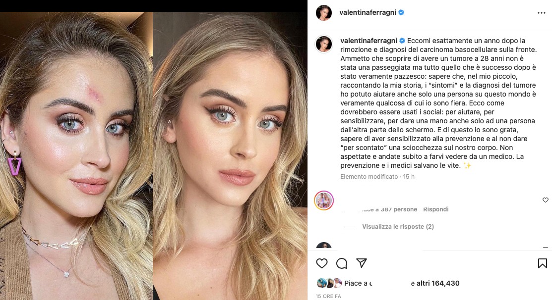 Galleria foto 'Valentina Ferragni, un anno dopo mostra la cicatrice del tumore' - foto 1