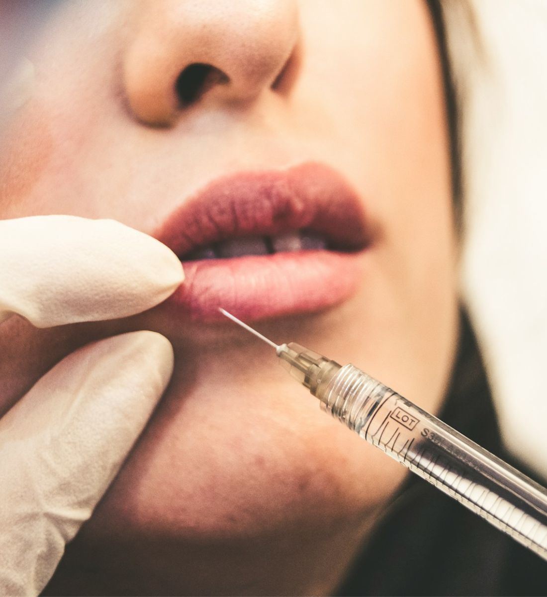 Galleria foto 'Botox o filler? Ecco le differenze per scegliere tra l’uno e l’altro' - foto 2