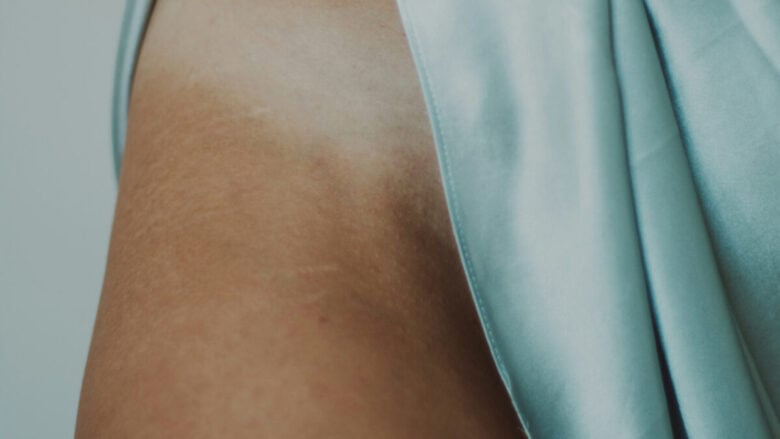 Bye bye smagliature: le creme e i trattamenti da non perdere per una pelle senza imperfezioni