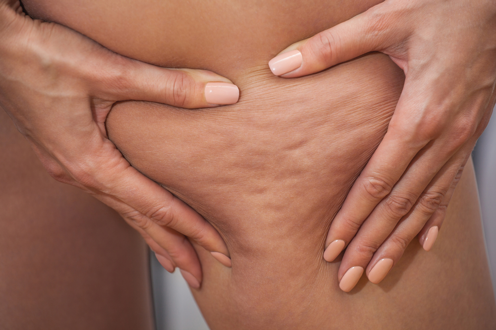 pizzicare pelle cellulite